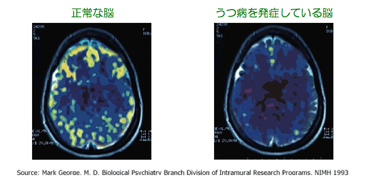 正常な脳とうつ病を発症している脳
